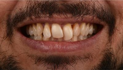 Extra-oral situation Fabbri N1