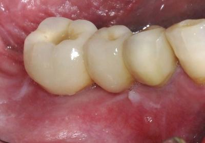1 year clinical view molar implants after GBR Clinical Study Aleksic EAO 2021