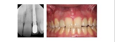 5 years clinical study narrow implants