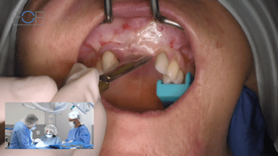 Malmquist live surgery pt 2