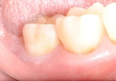 One year follow-up Fabbri EAO