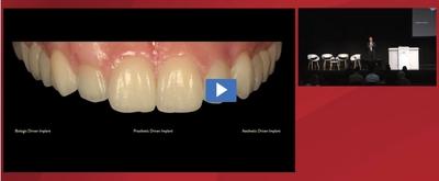 Goals of Implant Treatment
