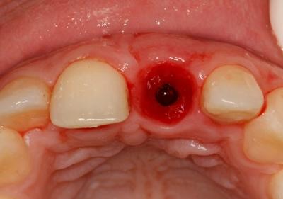 occlusal