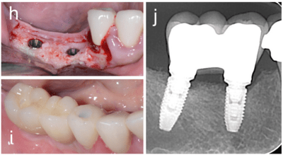 Implants After GBR with Wound Dehiscence