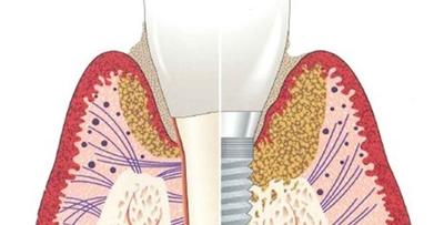 Periimplantitis 2