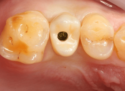 Implant