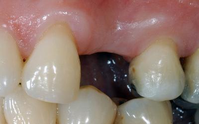 Consensus on single tooth_cover image.jpg