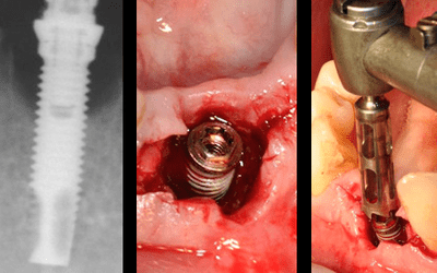 Consensus-on-the-avoidance-and-management-of-complications-of-implant-based-treatment-cover-image.png