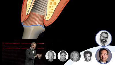 Immediate implants Episode 4: Influence of the emergence profile on success