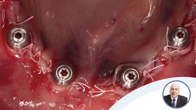 Full thickness flap All-on-4® surgery with Enrico Agliardi