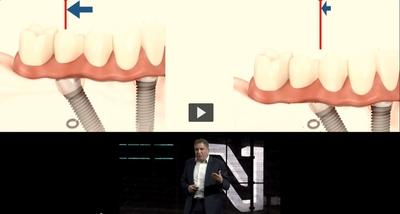The severely atrophic mandible - Immediate Function episode 4