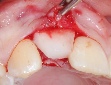Soft tissue augmentation with a collagen-based 3D matrix