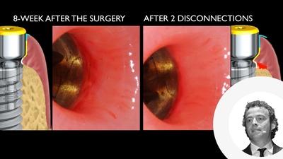 Giacomo Fabbri: Preserve soft tissue for long term success
