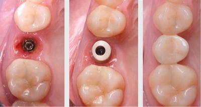 Clinical performance of anodized abutments and gradually anodized implant surface