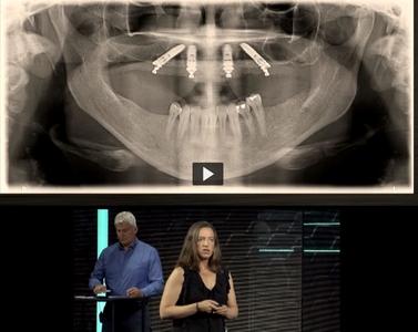 A patient with an edentulous maxilla and medium bone density – Immediate Function Episode 1