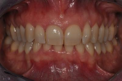 Gingival recession coverage with a xenogenic collagen matrix