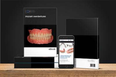 eBook: Implant overdentures: From Diagnosis to Maintenance