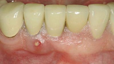 Peri-implant pathology risk assessment tool