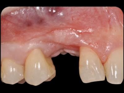 Initial clinical situation. The pre-operative buccal view is showing a missing canine associated with mucogingival deformities as the results of a traumatic extraction of the retained canine. A bone graft was attempted as well as an implant insertion: both bone graft and implant failed.